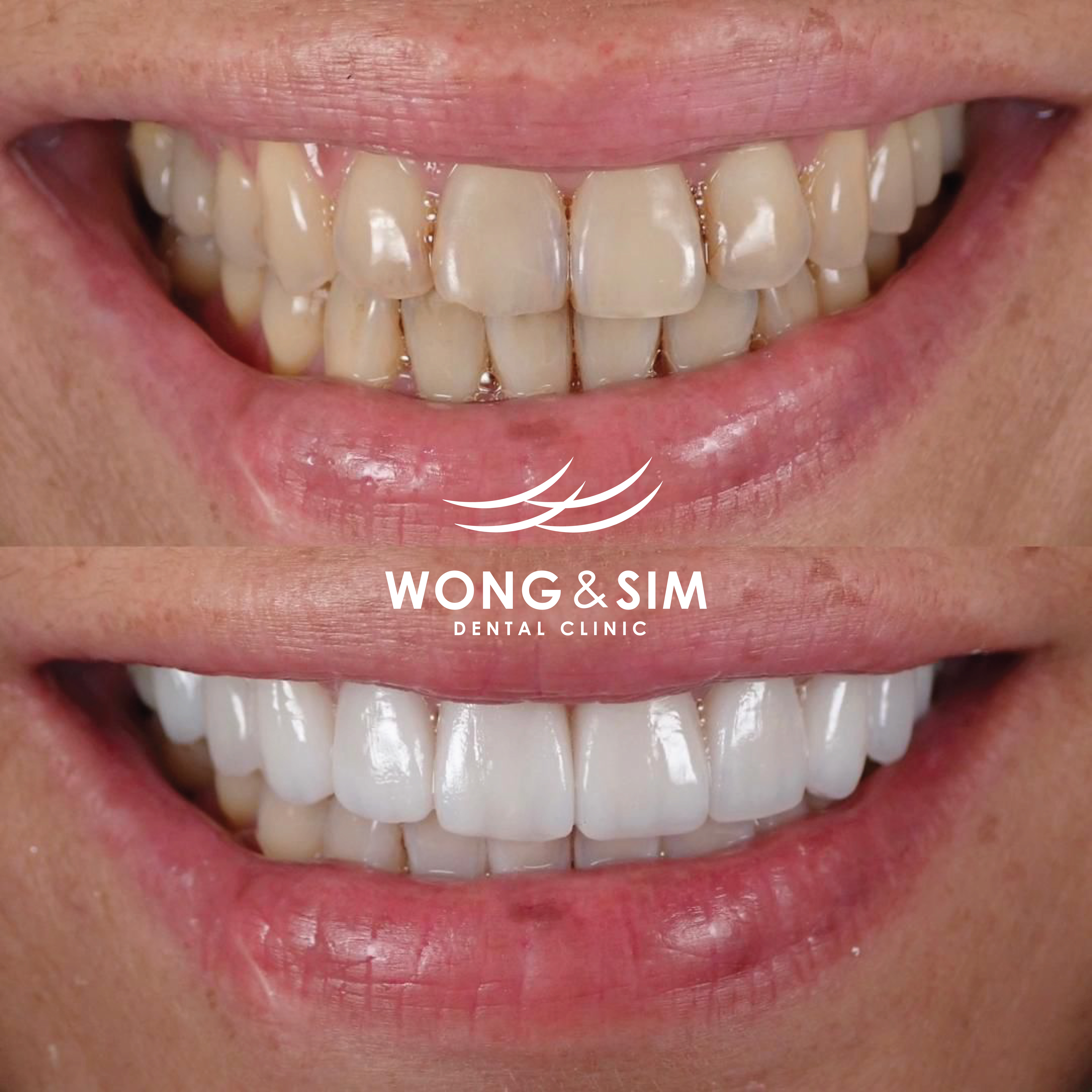 Patient 8 - Braces Before and After